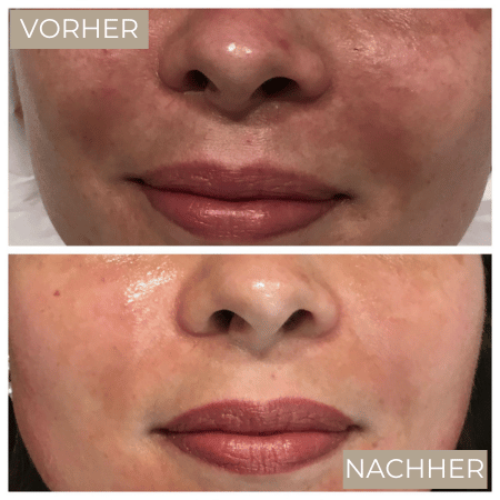 Vorher  Nachher Radiofrequenz Mikroneedling.png