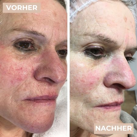 Vorher Nachher Rosacea 4.jpg