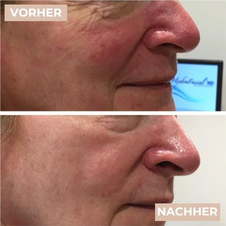 Vorher Nacher Rosacea 1.jpg