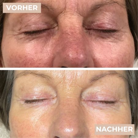 Vorher Nacher Rosacea 3.jpg