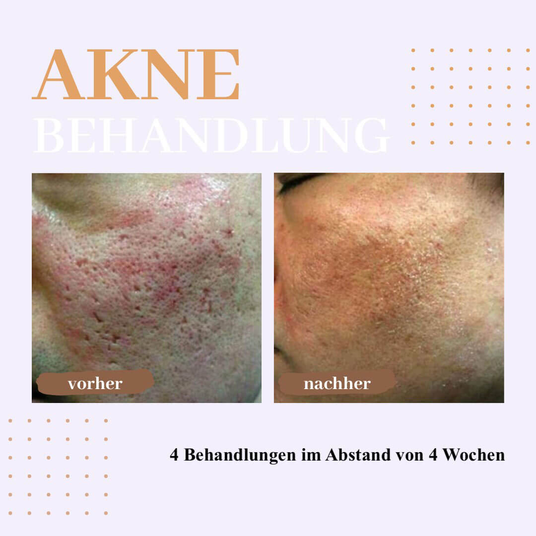 tesla-v-skin-akne-behandlung.jpg