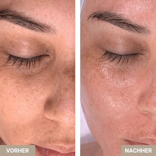 1b9744a8b-dfbd-11e9-99fe-0697e5ca793e_8ef9c6eedeee1a2ee0ebd9974f54f718f8c90fff_Kopie von Vorher- Nachher Bilder HydraFacial  AquaFacial.png