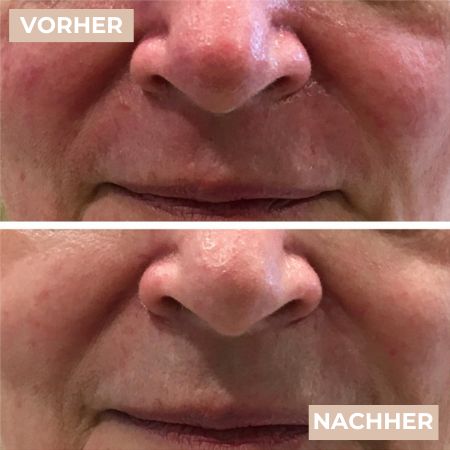 Vorher Nacher Rosacea 2.jpg