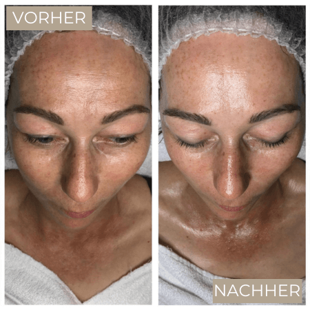 Vorher  Nachher Radiofrequenz Mikroneedling (1)-2.png