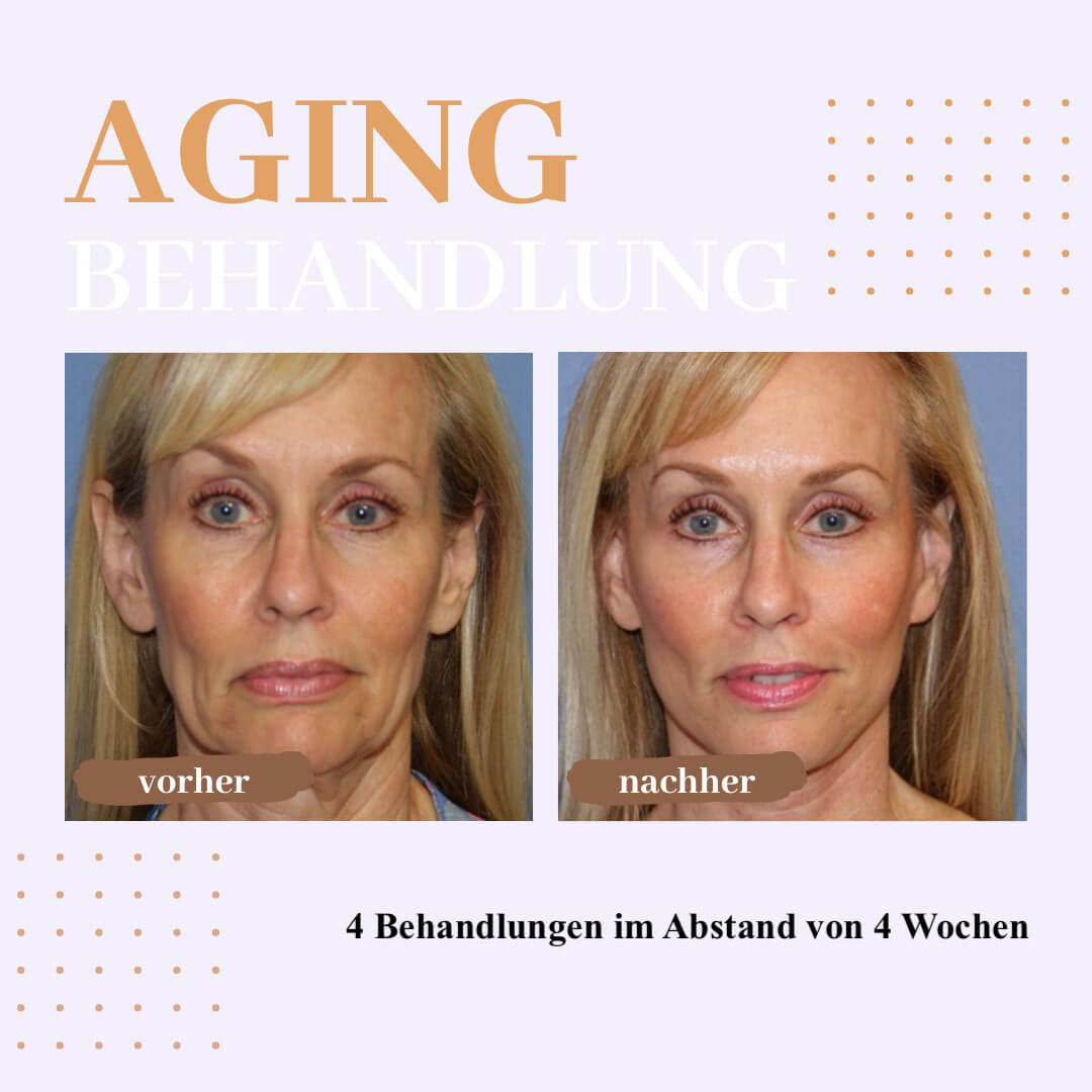 tesla-v-skin-aging-behandlung.jpg