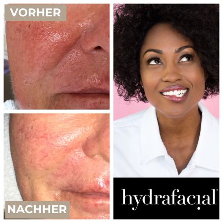 Vorher  Nachher Radiofrequenz Mikroneedling (1).jpg