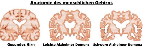 Veränderung des Gehirns durch Alzheimer Alzheimer Verlauf Gehirn