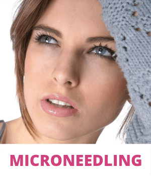 microneedling