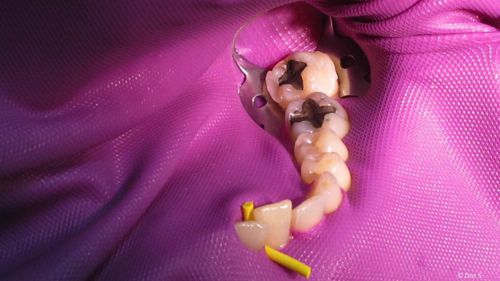 Kofferdam zur Abdeckung des gesamten Mundraumes bei der Amalgamentfernung