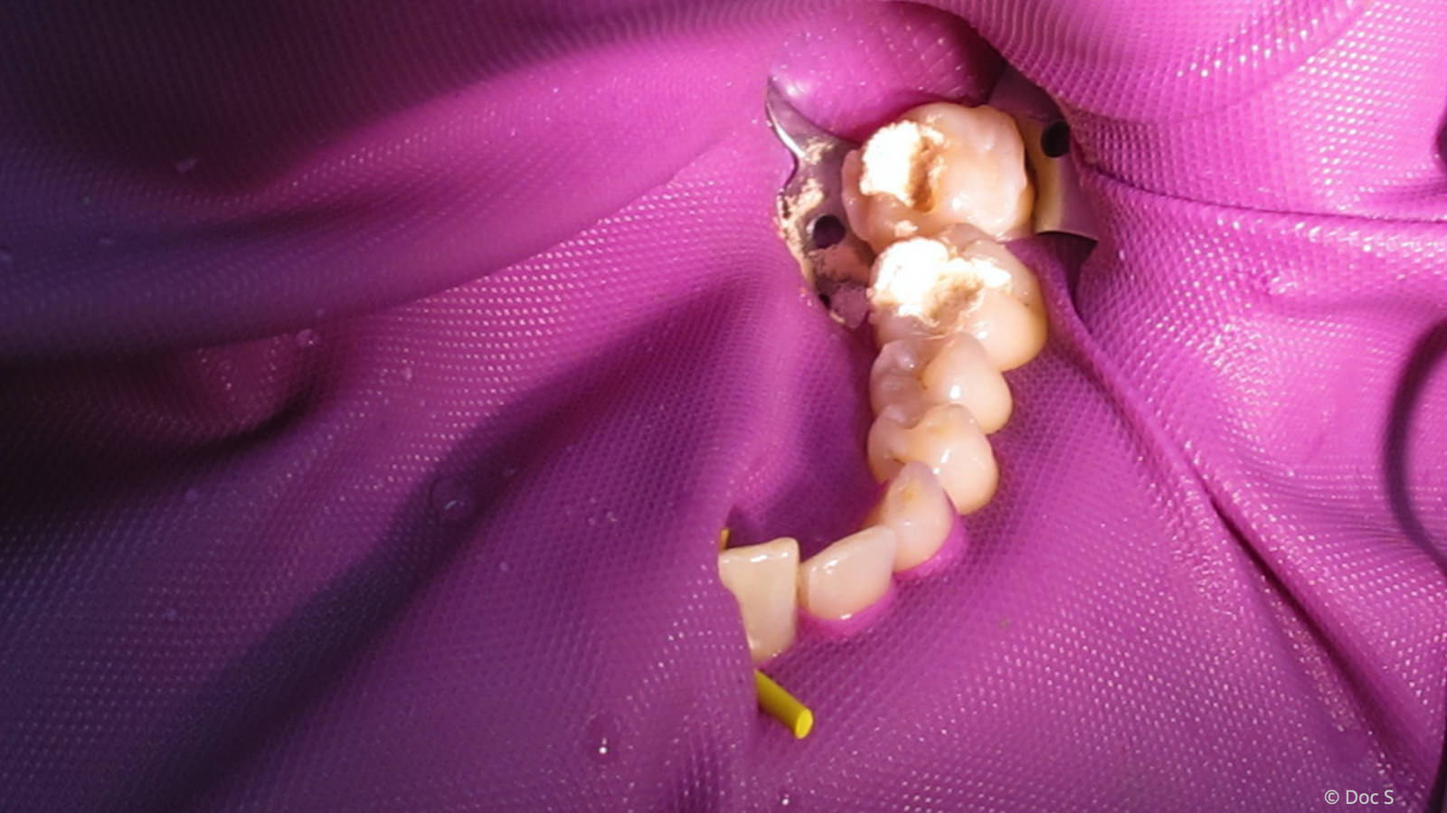 Algenpulver saugt nach der Amalgamentfernung Quecksilber aus dem Zahn auf.