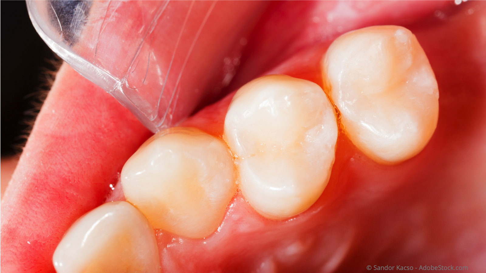 Komposit-Füllungen in den Zähnen: Stabil, lange haltbar und farbstabil