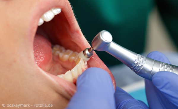 Parodontosebehandlung: Regelmäßige Zahnsteinentfernung in der Erhaltungstherapie