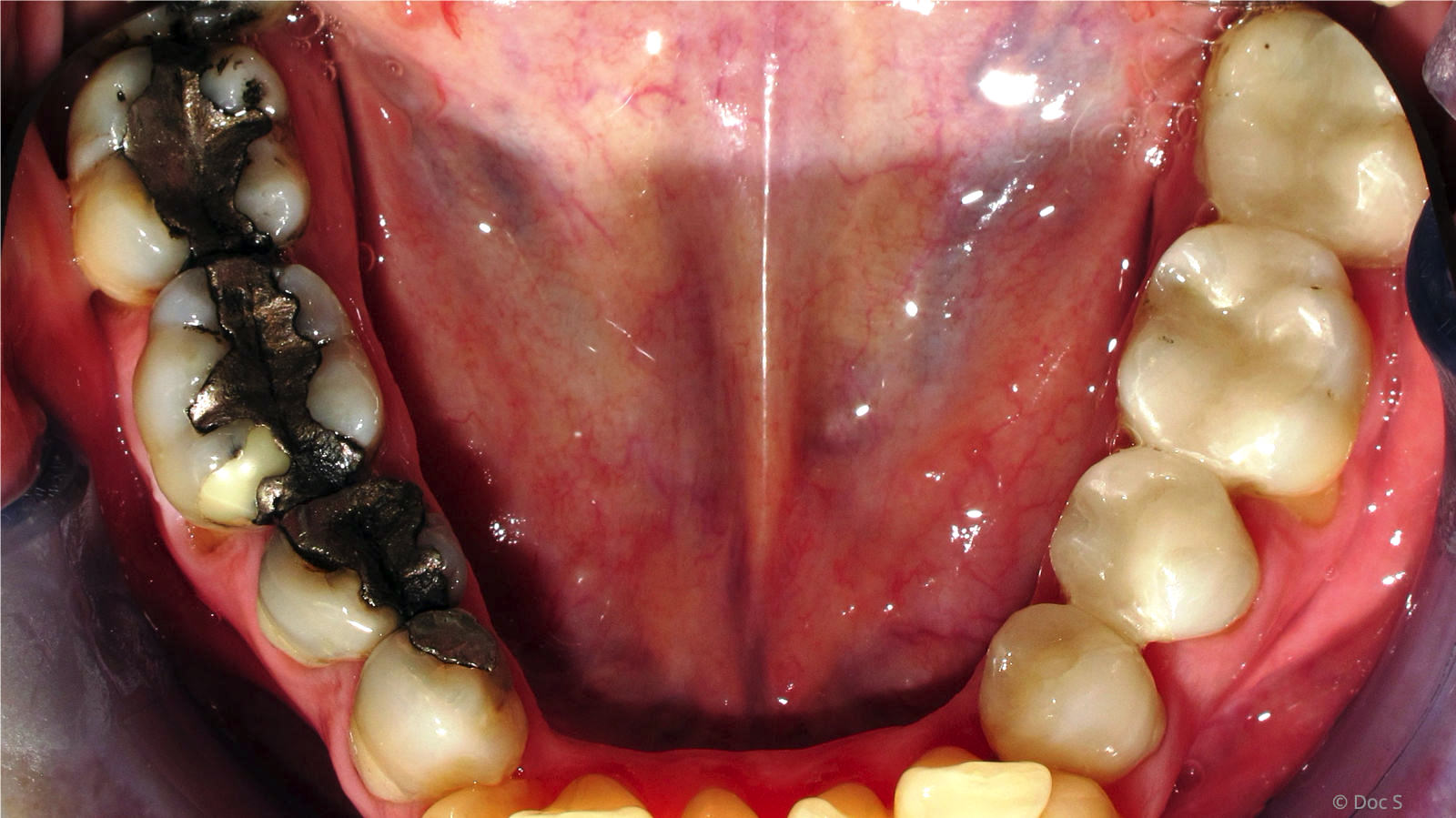 Links: Amalgam-Füllungen. Rechts: Keramik-Inlays