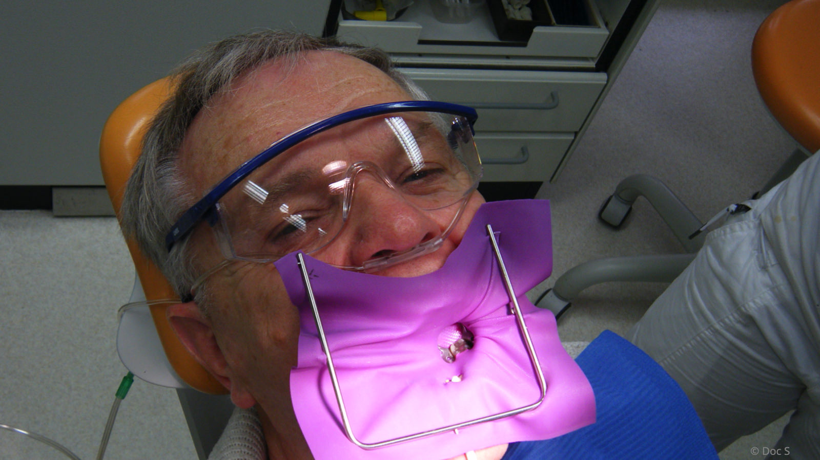 Schutz der Augen bei der Amalgamentfernung mit einer dicht anliegenden Brille