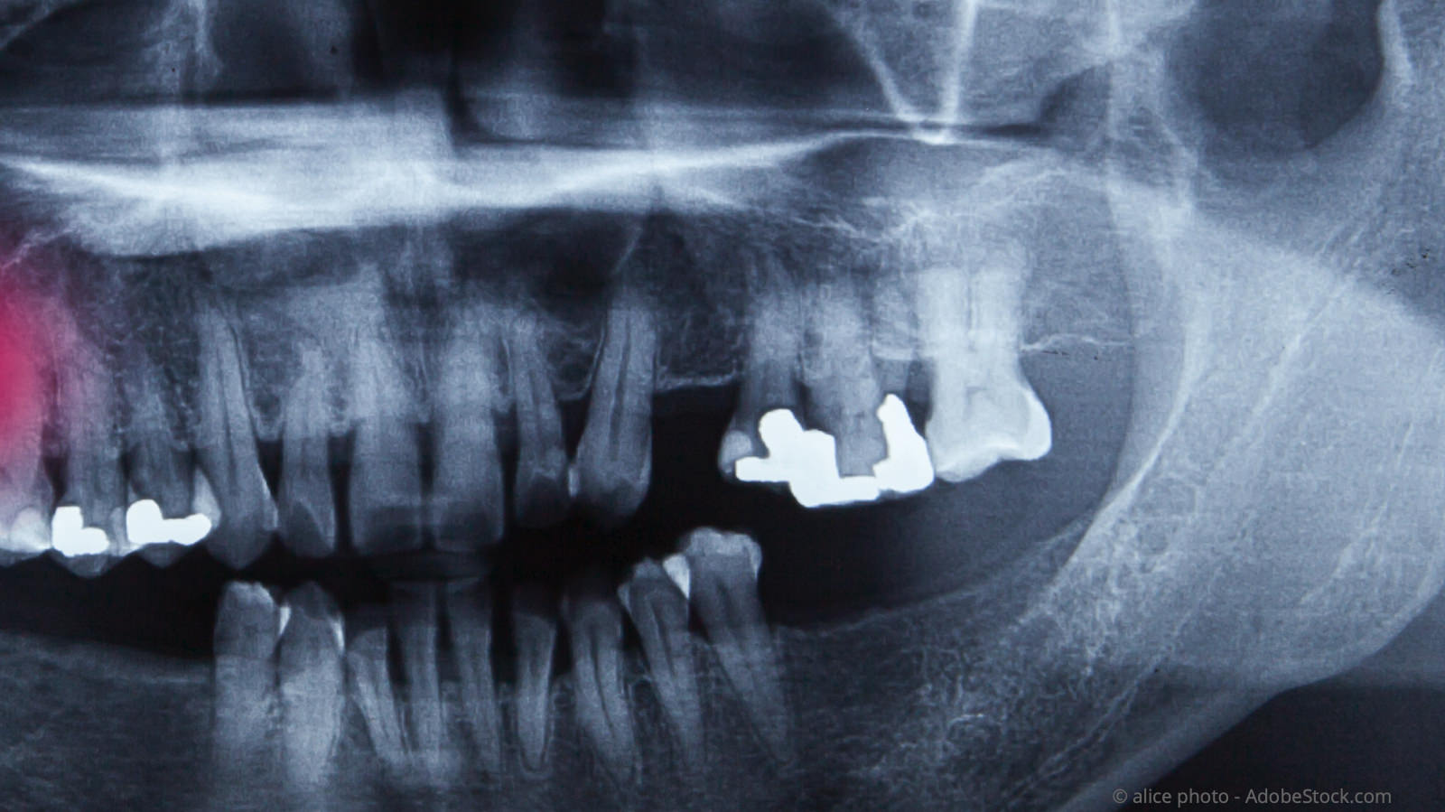 Die vorherige Kontrolle der Füllungstiefe auf dem Röntgenbild ist wichtig, um Verletzungen des Zahnnervs zu vermeiden.