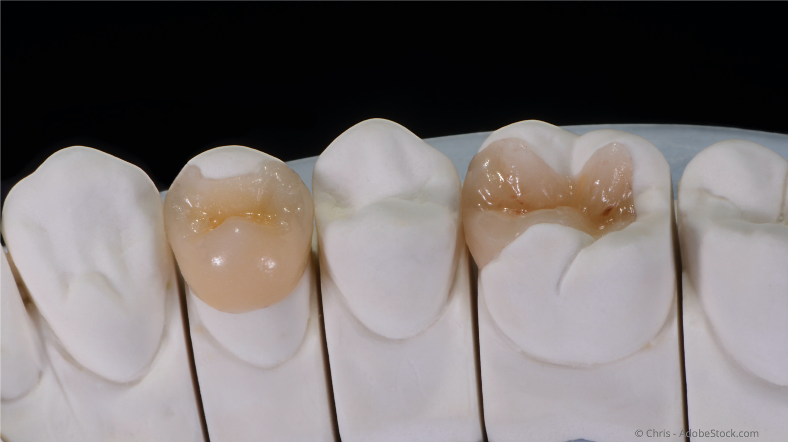 Hochwertige und langlebige Inlays aus reiner Keramik