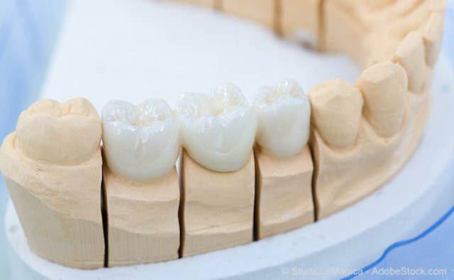 Von der richtigen Zahnzusatzversicherung werden auch Behandlungen bezuschusst, die vor Vertragsabschluss empfohlen wurden.
