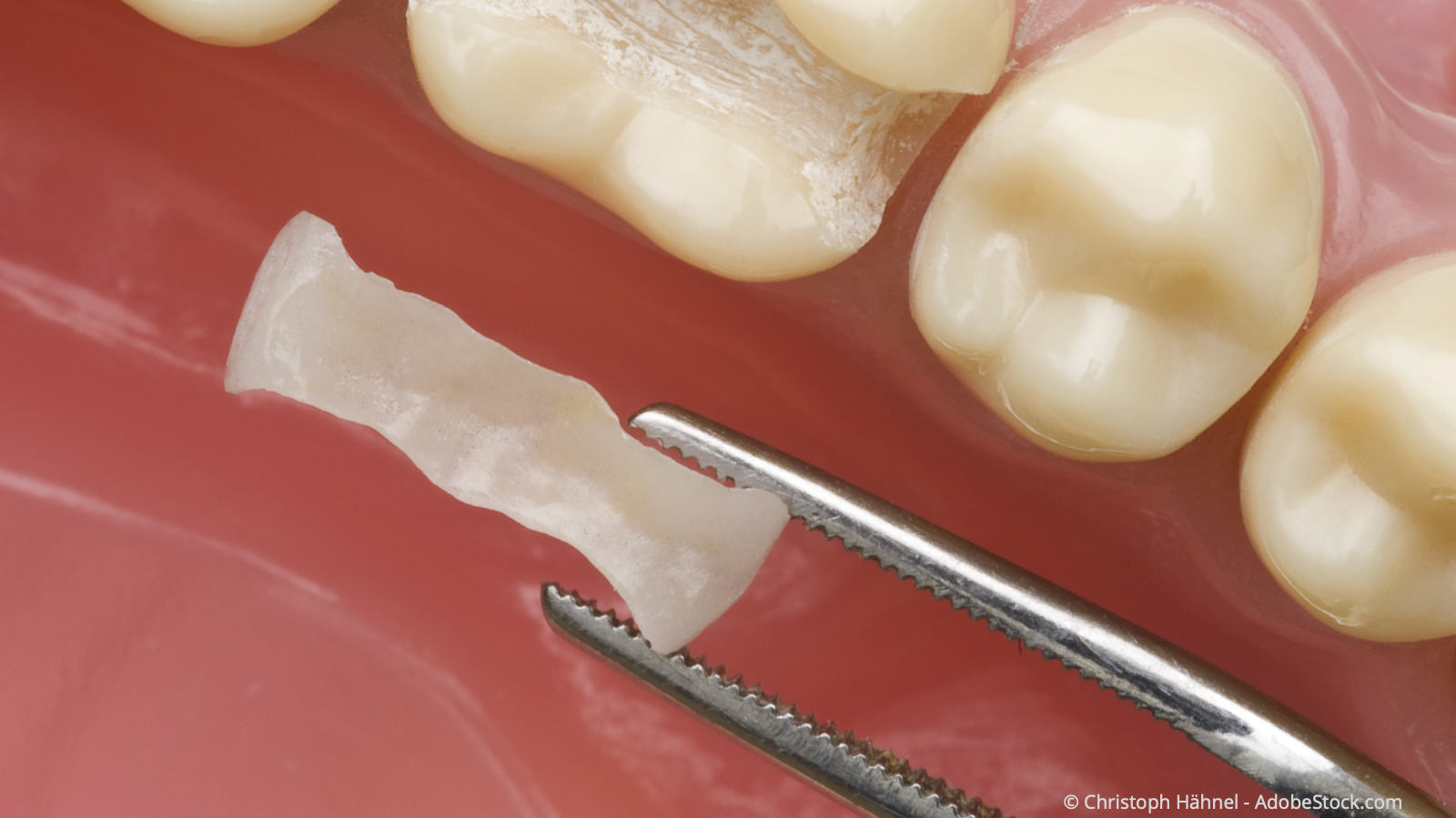 CEREC: körperverträgliche Inlays aus reiner Keramik in nur einem Termin