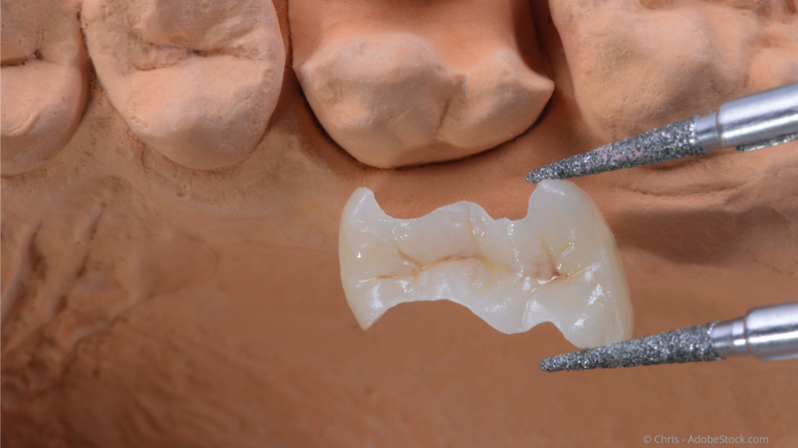 Metallfreie Alternativen zum Amalgam