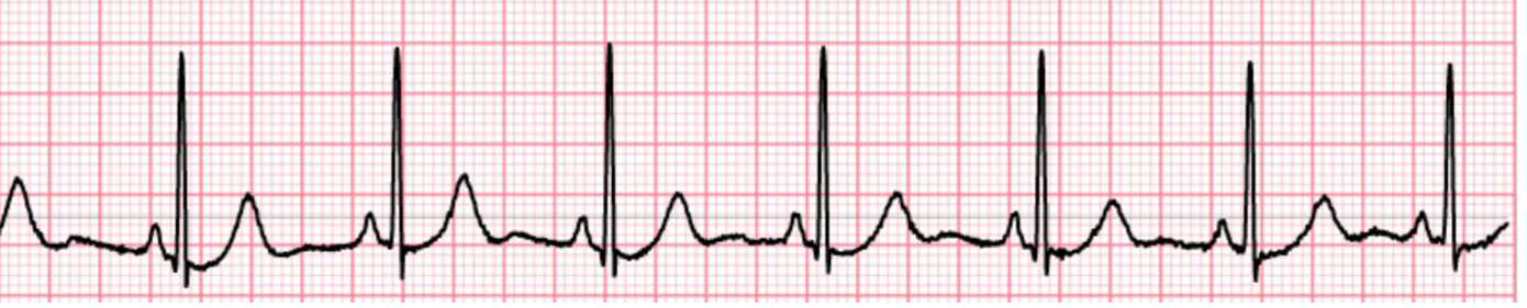 EKG Sinusrhythmus