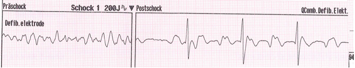 EKG Schockabgabe