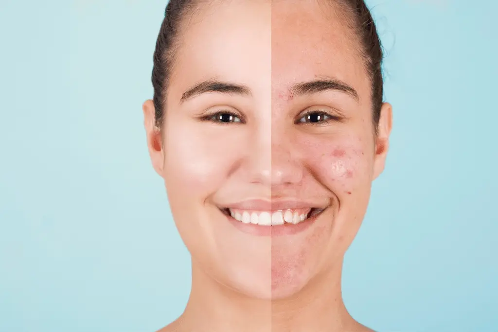 06_Microneedling_Elmera-Kosmetik_Behandlungen_-Make-It-Media_Nuernberg-Fuerth-Erlangen.webp