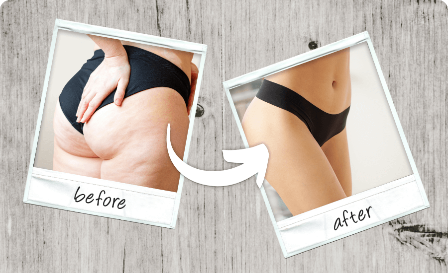 Vorher_Nachher_Cellulite-2.png