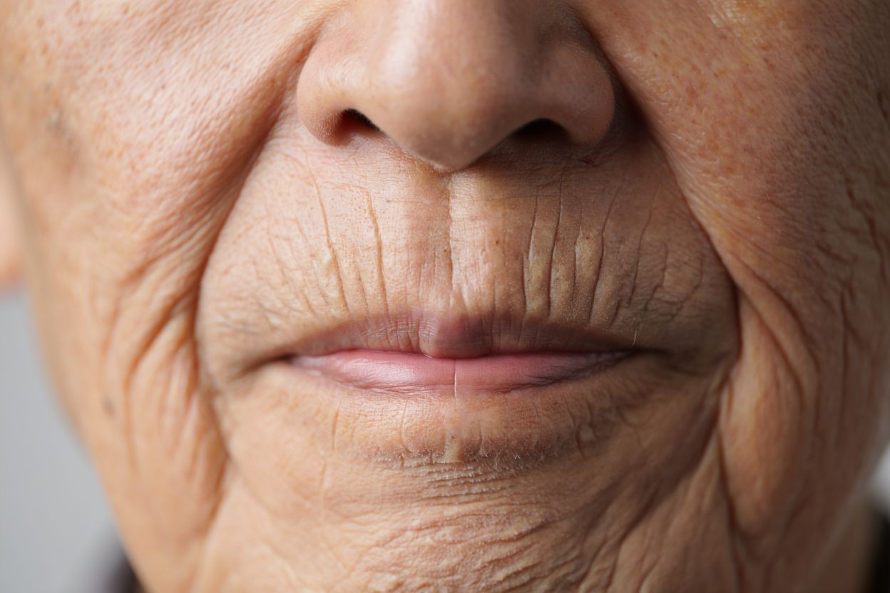 Perioralfalten.jpeg