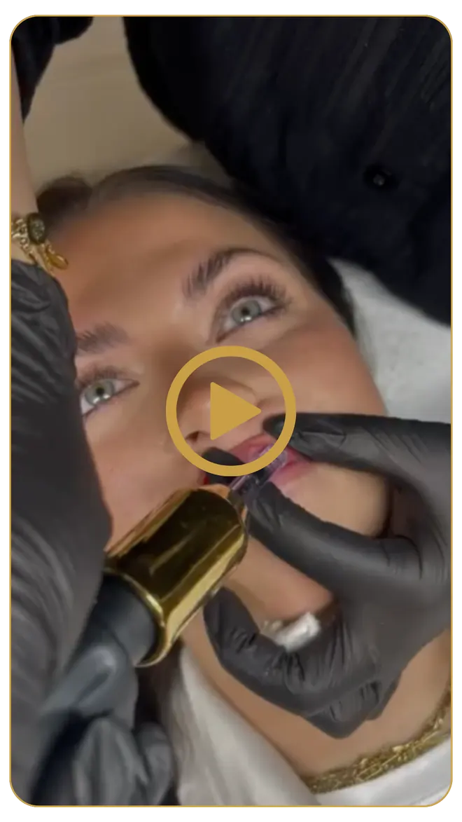 Video: Behandlung mit dem IRI® Filler-System bei SAHA Kosmetik